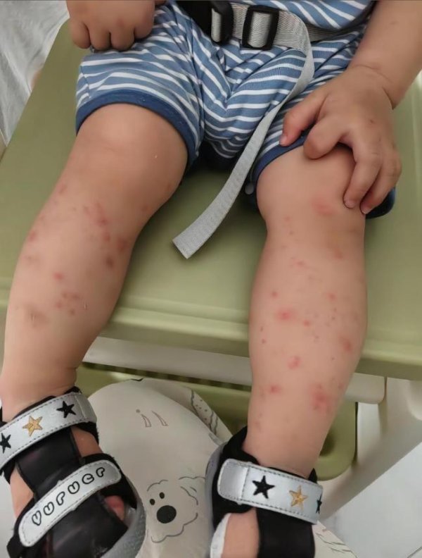 网上配资炒股网站 强搂亲吻孩子致水痘双方已达成和解 亲密接触引发传染风险